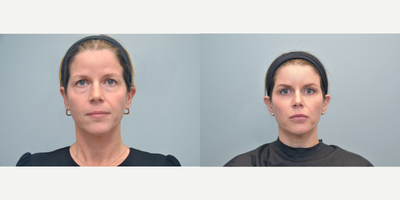 Dermal Fillers before and after photo