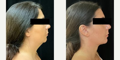Liposuction before and after photo