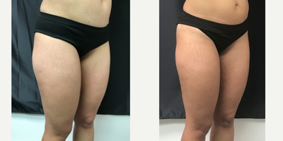 SculpSure before and after photo