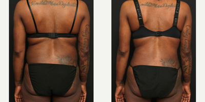 Vaser Liposuction before and after photo