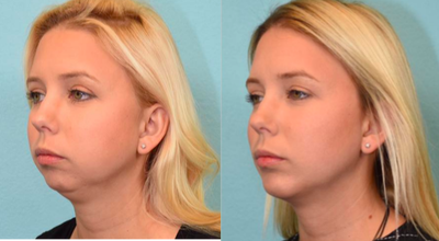 Chin Implant before and after photo