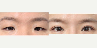 Eyelid Surgery before and after photo