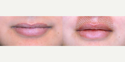 Lip Fillers before and after photo