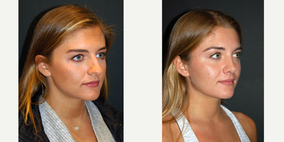 Rhinoplasty before and after photo