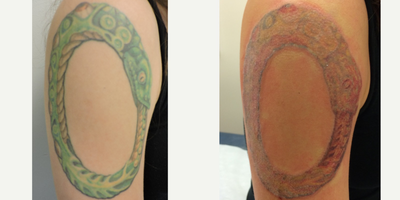 Tattoo Removal before and after photo