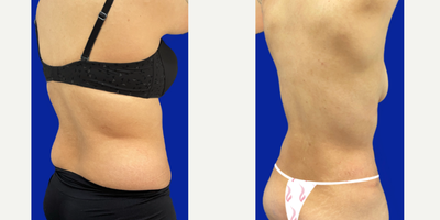 Tummy Tuck before and after photo