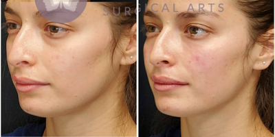 Dermal Fillers before and after photo