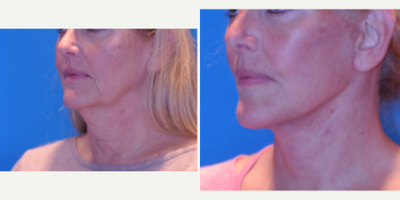 Facelift before and after photo