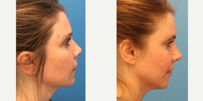 Laser Peel before and after photo