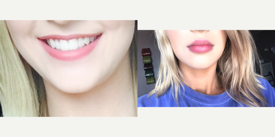 Lip Fillers before and after photo