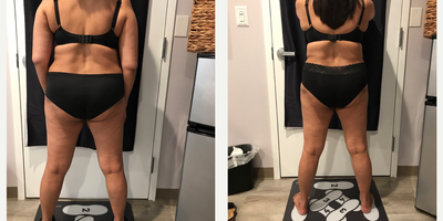 SculpSure before and after photo