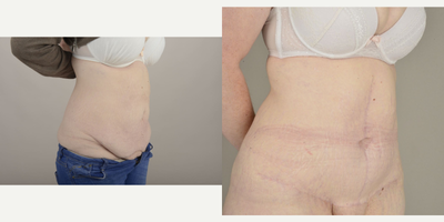 Tummy Tuck before and after photo
