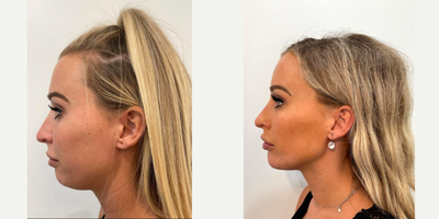 Chin Filler before and after photo