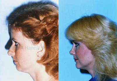 Chin Implant before and after photo