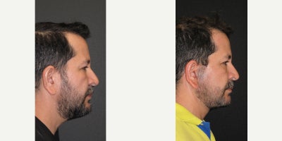 Deep Plane Facelift before and after photo