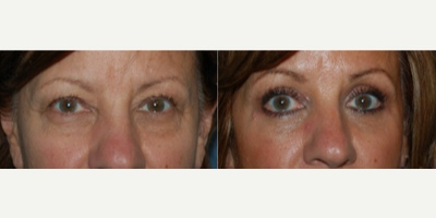 Eyelid Surgery before and after photo