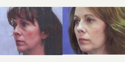 Eyelid Surgery before and after photo