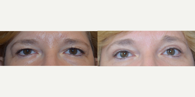 Eyelid Surgery before and after photo