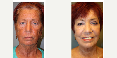 Facelift before and after photo