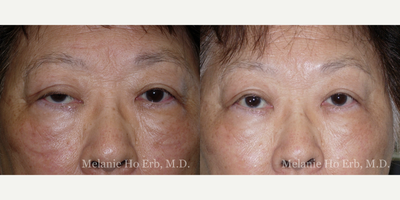 Ptosis Surgery before and after photo