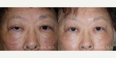 Ptosis Surgery before and after photo