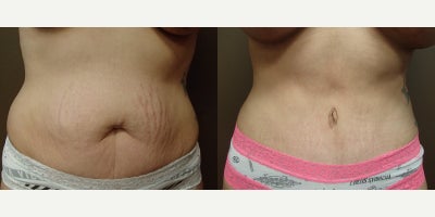 Tummy Tuck before and after photo