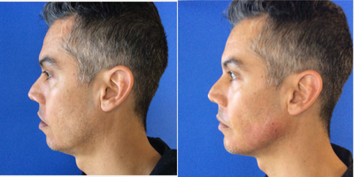 Voluma before and after photo