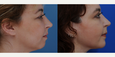 Chin Implant before and after photo
