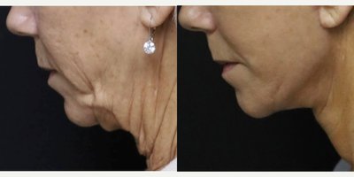 CO2 Laser before and after photo