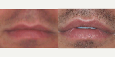 Dermal Fillers before and after photo