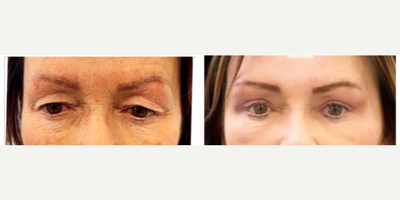 Double Eyelid Surgery before and after photo