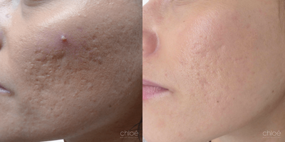 Fractional Laser before and after photo
