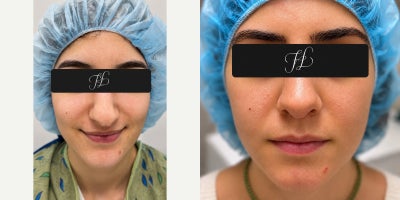 Rhinoplasty before and after photo