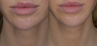 Chin Filler before and after photo