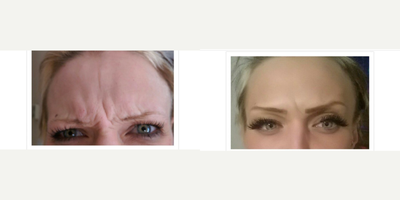 Dysport before and after photo