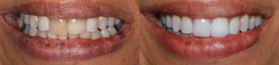 Porcelain Veneers before and after photo