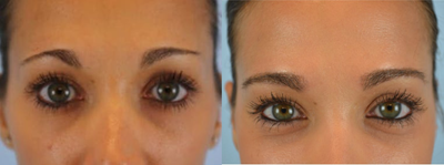 Eyebrow Transplant before and after photo