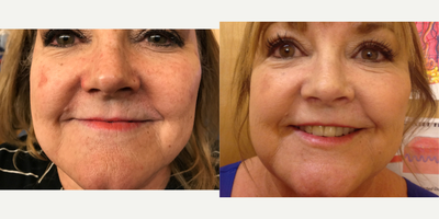 Juvederm before and after photo