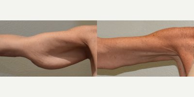 Arm Lift before and after photo