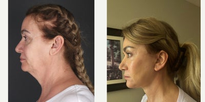 Deep Plane Facelift before and after photo