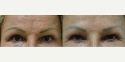 Dysport before and after photo