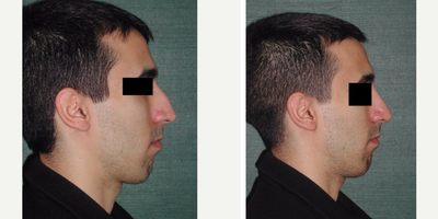Rhinoplasty before and after photo