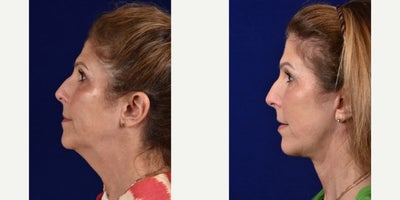 Brow Lift before and after photo