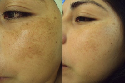 Chemical Peel before and after photo