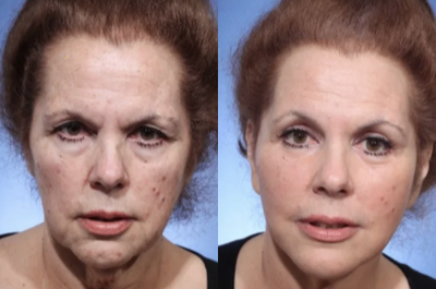 Deep Plane Facelift before and after photo