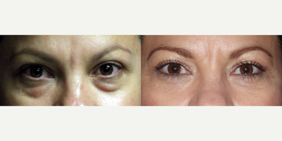 Eyelid Surgery before and after photo