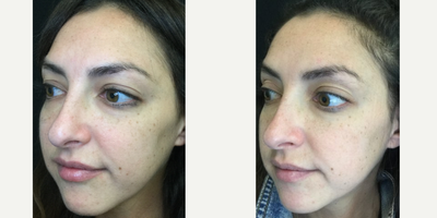 Microneedling before and after photo