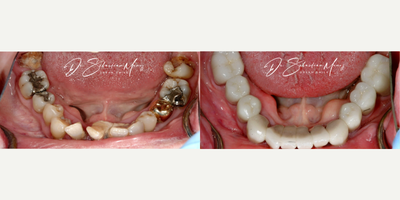 Dental Crown before and after photo