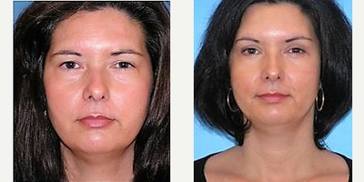 Eyelid Surgery before and after photo