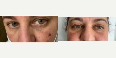 IPL before and after photo